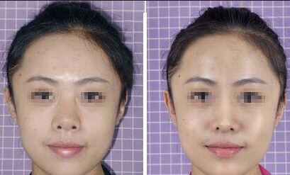 膨體隆鼻后遺癥的出現(xiàn)有哪些？危害大嗎？