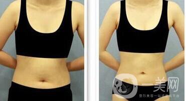 做一次環(huán)形吸脂手術(shù)價格是多少？