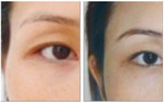 豐太陽穴手術(shù)的價格一般是多少