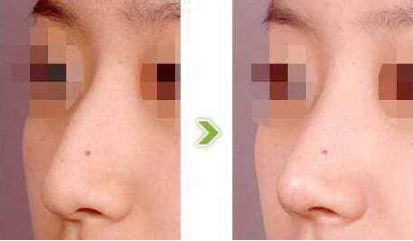 駝峰鼻有哪些類型？駝峰鼻矯正方法全解