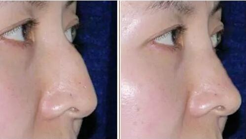 駝峰鼻有哪些類型？駝峰鼻矯正方法全解