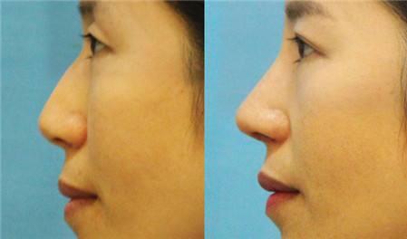 駝峰鼻整形術(shù)后注意事項有哪些？