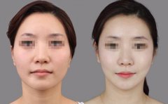 南寧華美整形做顴骨整形手術(shù)怎么樣