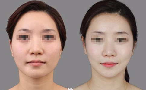 南寧華美整形做顴骨整形手術怎么樣