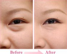 北京激光祛眼袋多少錢