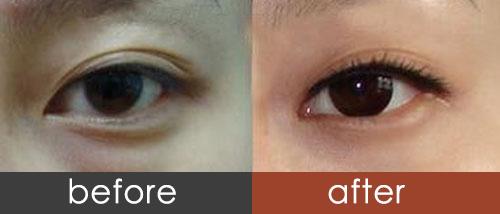 深圳內(nèi)切祛眼袋手術(shù)價(jià)格