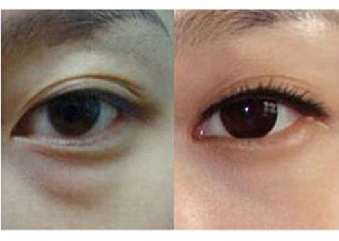 上海內(nèi)切祛眼袋費用是多少