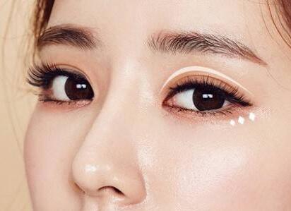 北京雙眼皮埋線價(jià)格