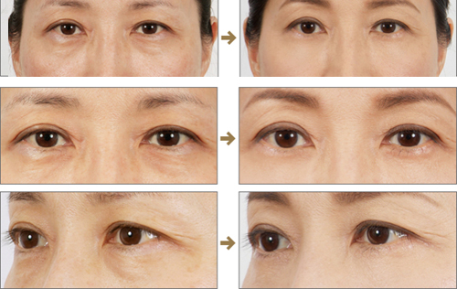 北京內(nèi)切祛眼袋多少錢(qián)