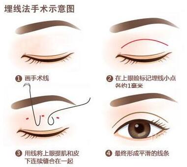 上海埋線雙眼皮價(jià)格多少