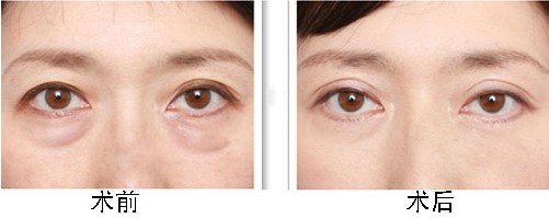 上海激光祛眼袋價(jià)格是多少