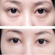 深圳激光祛眼袋手術(shù)價格是多少