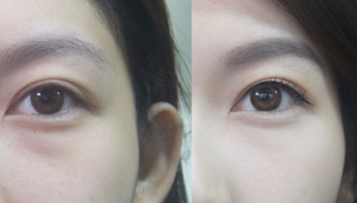 廣東超聲波祛眼袋價(jià)格