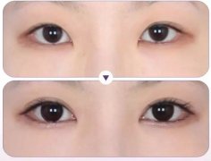 深圳眼部手術(shù)整形價(jià)格是多少