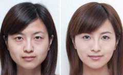 深圳超聲波祛眼袋價格