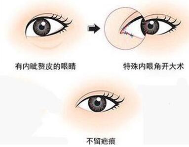 深圳開(kāi)眼角多少錢