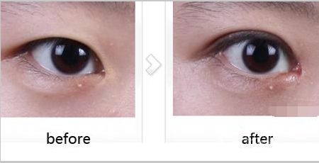 廣東,開外眼角,價(jià)格