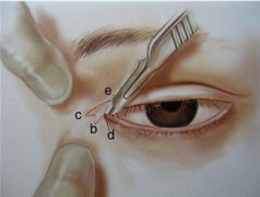 上海做開眼角大概多少錢