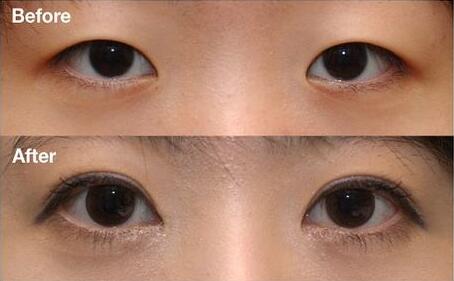 上海做開眼角大概多少錢