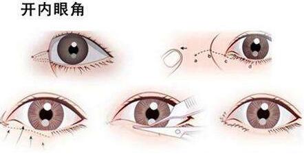 北京開內(nèi)眼角多少錢