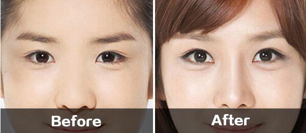 深圳開(kāi)內(nèi)眼角價(jià)格是多少