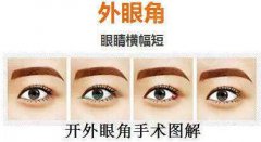 深圳開內(nèi)眼角價格是多少