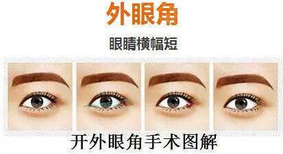 深圳開內(nèi)眼角價(jià)格是多少