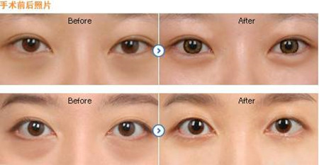 深圳去除黑眼圈手術(shù)價格是多少