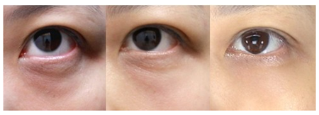 深圳去除黑眼圈手術(shù)價格是多少