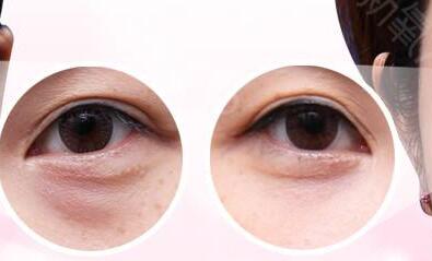 北京,玻尿酸,去黑眼圈,價(jià)格