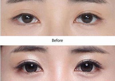 廣東眼部整形失敗修復(fù)手術(shù)費(fèi)用