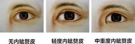 上海眼部整形失敗修復價格