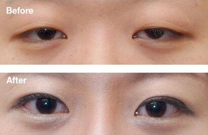 廣東下眼下至手術(shù)費(fèi)用