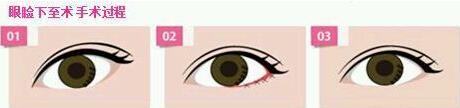 北京下眼下至術多少錢