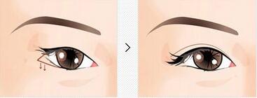 北京下眼下至術多少錢