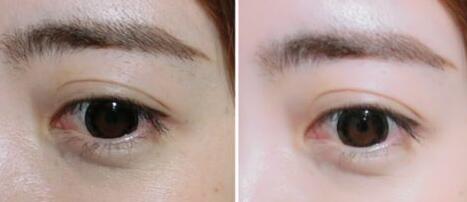 廣東,玻尿酸去黑眼圈,多少錢