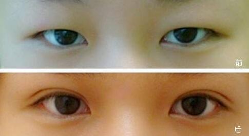 上海上眼瞼抽脂多少錢