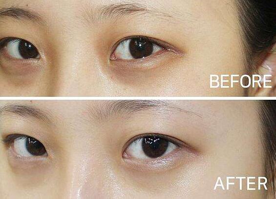 深圳,玻尿酸去黑眼圈,多少錢