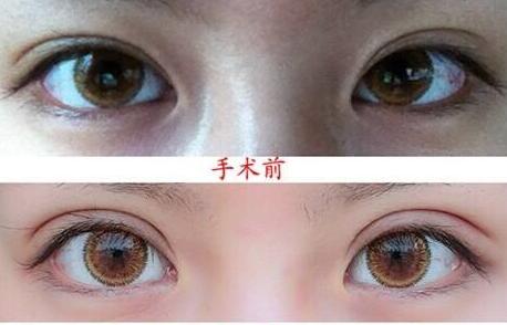 上海,眼瞼整形,手術(shù)費(fèi)用