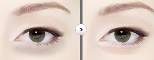 廣東,眼瞼整形,價(jià)格