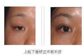 上海,上眼瞼提肌,手術(shù),多少錢