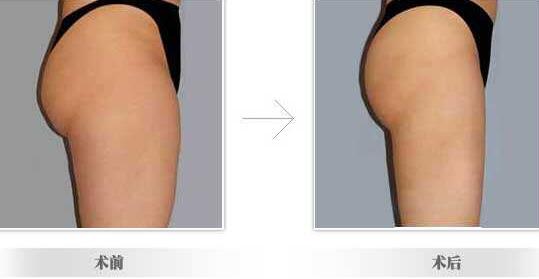臀部共振吸脂,多少錢