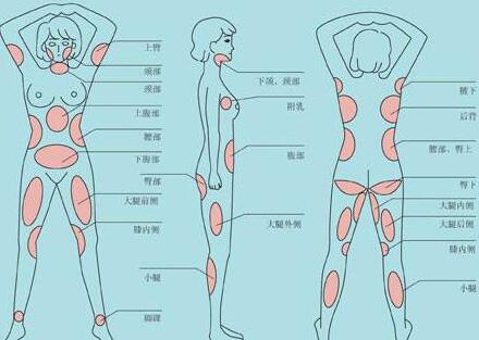南京吸脂減肥價格是多少？