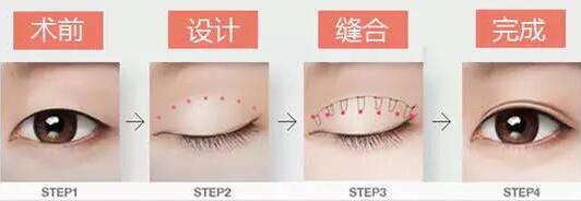 焊接雙眼皮是什么？有哪些特點？