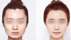 等離子激光溶脂價(jià)格是多少