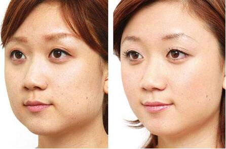 去頰脂墊價(jià)格是多少？貴不貴？