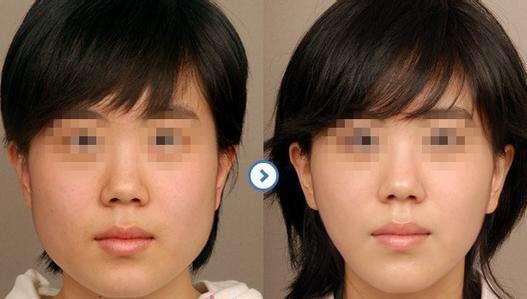 去頰脂墊價(jià)格是多少？貴不貴？