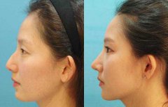 駝峰鼻矯正的調(diào)節(jié)費(fèi)用