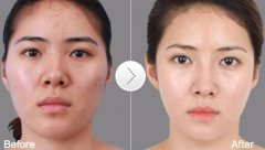 朝天鼻整容多少錢？