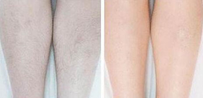 怎樣去除腿毛、*果怎么樣